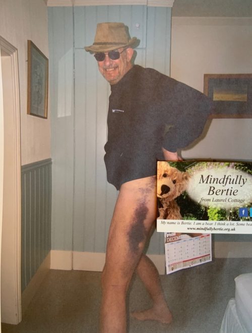 A trouserless Bobby sporting a massive bruise on his left leg. A "Mindfully Bertie" card is placed to conceal his embarrasment.